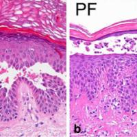 
	Pemphigus vulgaris - histopathology

	Typical…