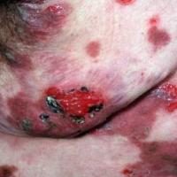 
	Pemphigus vulgaris

	&nbsp;