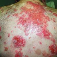 
	Pemphigus vulgaris