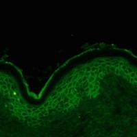 
	Pemphigus vulgaris - direct…