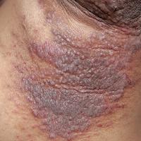 
	Pemphigus vegetans

	Copied with kind…