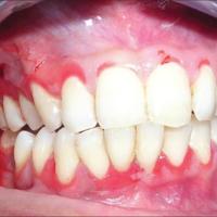 
	Pemphigus vulgaris

	Erosions can be seen on…