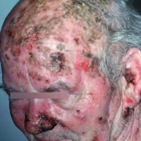 
	Pemphigus vulgaris

	&nbsp;