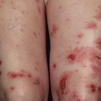 
	Pemphigus vulgaris

	Copied with kind…