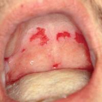 
	Pemphigus vulgaris