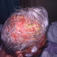
	Pemphigus vulgaris