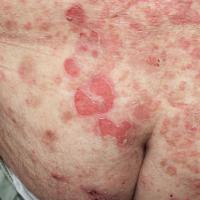 
	Pemphigus vulgaris