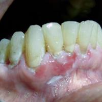 
	Pemphigus vulgaris