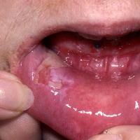 
	Pemphigus vulgaris