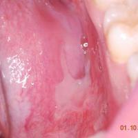
	Pemphigus vulgaris

	White mucosal surface