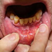 
	Pemphigus vulgaris&nbsp;

	Slow-healing erosions