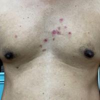 
Pemphigus vulgaris - same patient as previous…