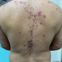 Pemphigus vulgaris
Copied with kind permission…