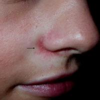 
	Perioral dermatitis

	Erythema of the…