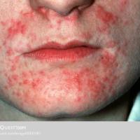
	Perioral dermatitis 

	Erythema, papules and…