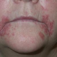 
	Perioral dermatitis induced by topical steroids…