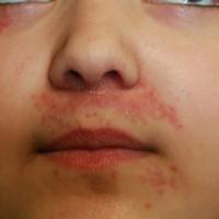 
	Perioral and periocular involvement

	Together…