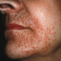 
	Perioral dermatitis

	Monomorphic papules