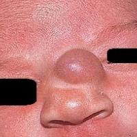 
	Nasal glioma