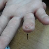 
	Amputation stump neuroma