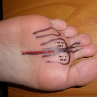 
	The site of Morton's neuroma