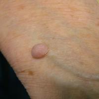 
	Solitary neurofibroma