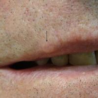 
	Schwannoma

	A small, intradermal lesion