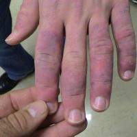
	Chilblain lupus