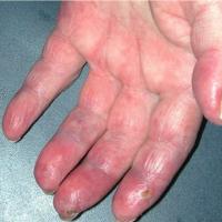 
	Chilblain lupus