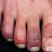 
	Chilblains
