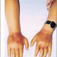 Erythropoietic protoporphyria 
