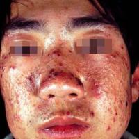 Hydroa vacciniforme