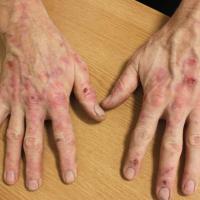 Pseudoporphyria&nbsp;