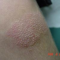 
	Type IV: Juvenile-onset circumscribed PRP