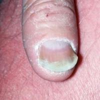 
	Pityriasis rubra pilaris

	Thickening of the…