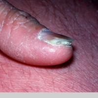 
	Pityriasis rubra pilaris