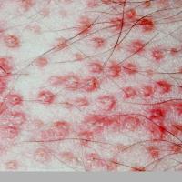 
	Pityriasis rubra pilaris

	Keratotic follicular…