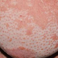 
	Pityriasis rubra pilaris

	Copied with kind…
