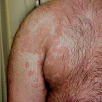 
	Pityriasis versicolor

	Same patient as…