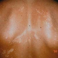 
	Pityriasis versicolor

	Lighter pigmentation…