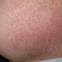 
	Polymorphic eruption of pregnancy