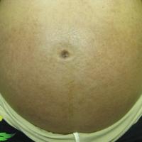 
	Polymorphic eruption of pregnancy