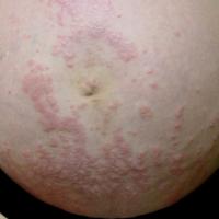 
	Polymorphic eruption of pregnancy