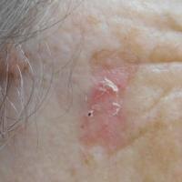
	Porokeratosis on the face

	Copied with kind…