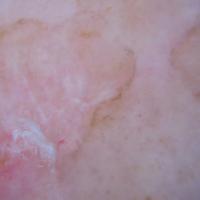 
	Dermoscopic image of the previous…
