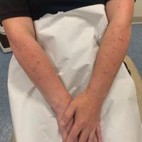 Disseminated superficial actinic…