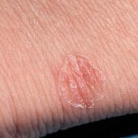 
	Porokeratosis of Mibelli - above the heel