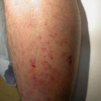 
	Disseminated superficial actinic porokeratosis…