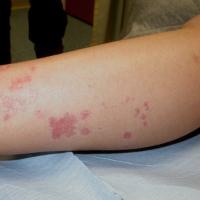 
	Linear porokeratosis 
