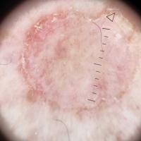 Dermoscopic appearance of previous image
Copied…